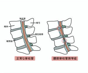 脊柱管狭窄症.jpegのサムネイル画像のサムネイル画像のサムネイル画像